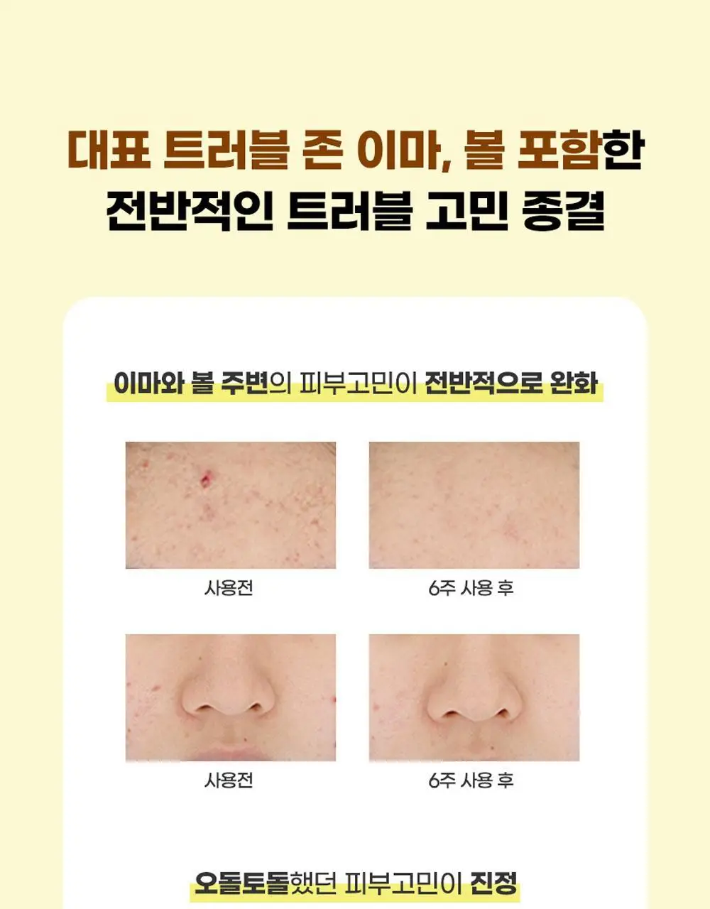 [트러블/과잉피지완화]앰플엔 아크네샷 앰플 30ml 상세페이지 18